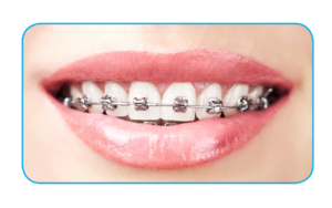 Close-up of a woman's mouth showing braces on her teeth